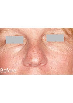 Nose Reshaping