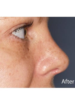 Nose Reshaping