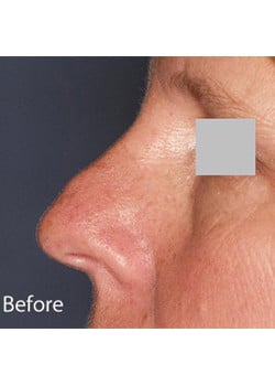 Nose Reshaping