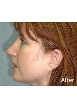 Nose Reshaping