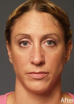 Nose Reshaping