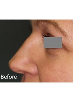Before Image: Nose Reshaping - other