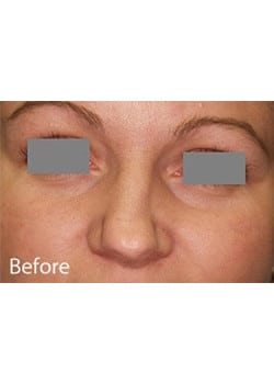 Nose Reshaping