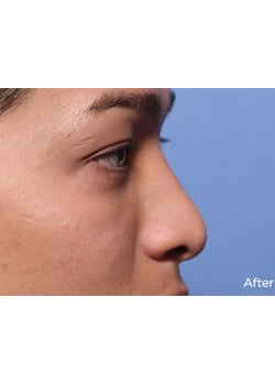 Nose Reshaping
