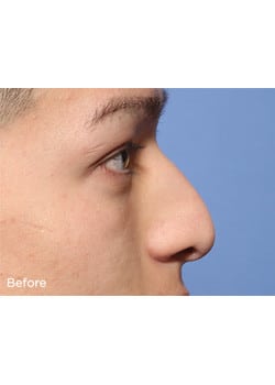 Nose Reshaping