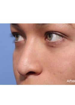 Nose Reshaping