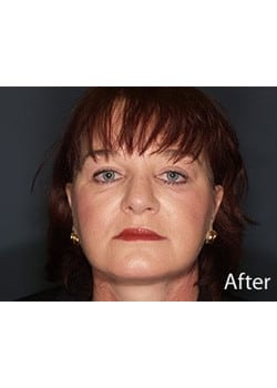 Facelift