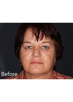 Facelift