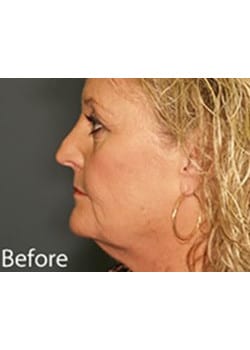 Facelift