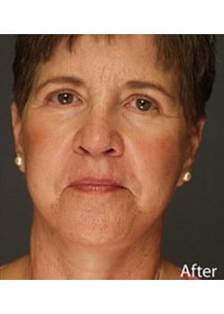 After Image: Facelift - front