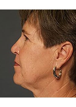 Facelift