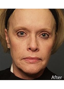 Facelift