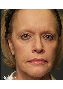 Facelift