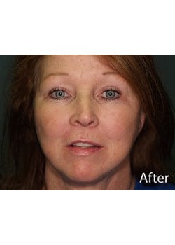 Facelift