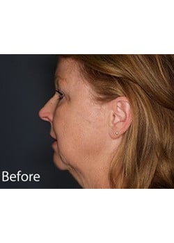 Facelift