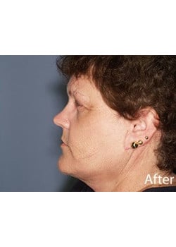 Facelift Case