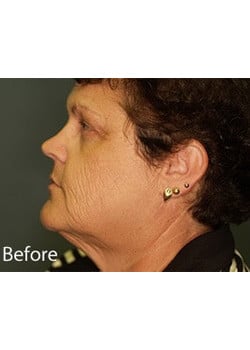 Facelift Case