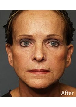 Facelift