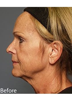 Facelift