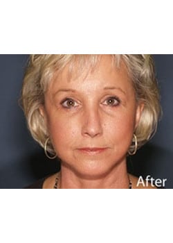 After Image: Facelift - front