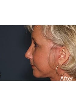 Facelift