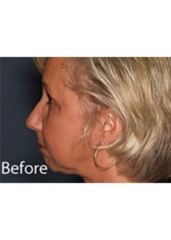 Facelift
