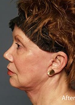 Facelift
