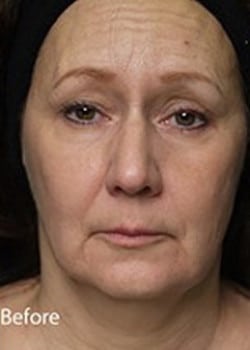 Before Image: Facelift - front