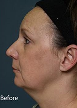 Facelift