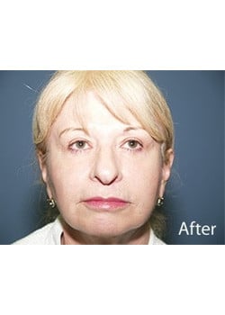 After Image: Facelift - front