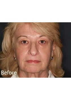 Before Image: Facelift - front