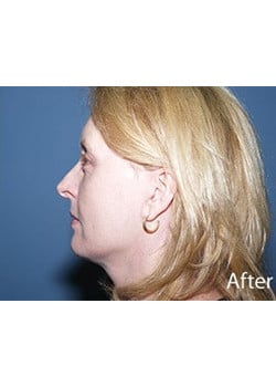 Facelift