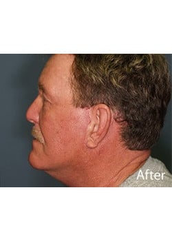 Facelift