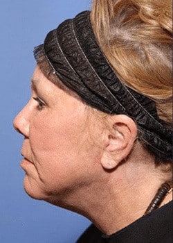 Facelift