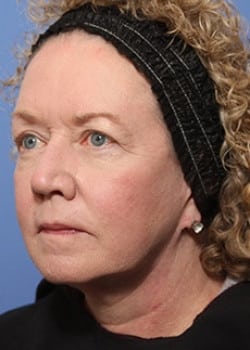 Before Image: Facelift - left-front-oblique