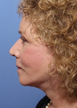 After Image: Facelift - other