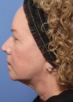 Before Image: Facelift - other