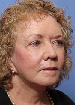 After Image: Facelift - right-front-oblique