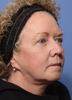 Before Image: Facelift - right-front-oblique