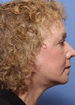 Facelift