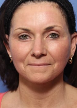 After Image: Facelift - front