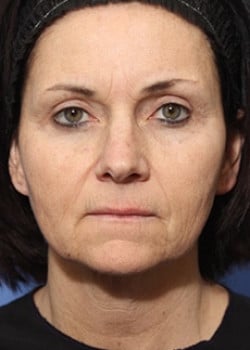 Before Image: Facelift - front