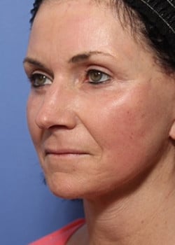 After Image: Facelift - left-front-oblique