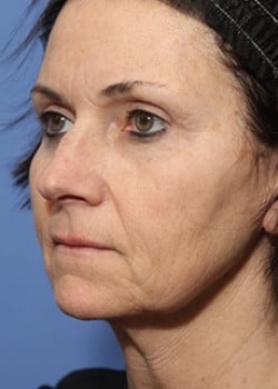 Before Image: Facelift - left-front-oblique