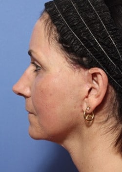 After Image: Facelift - other
