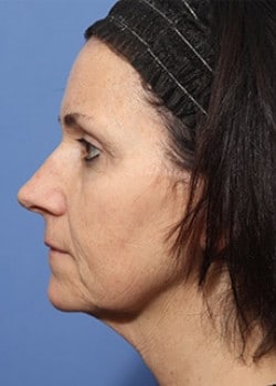 Before Image: Facelift - other