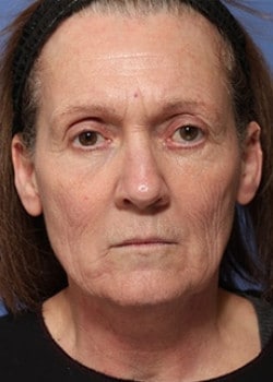 Before Image: Facelift - front