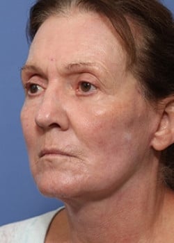 After Image: Facelift - left-front-oblique