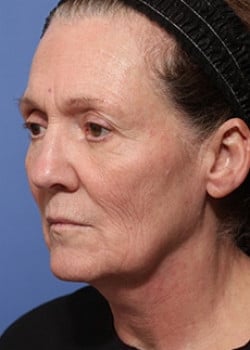 Before Image: Facelift - left-front-oblique