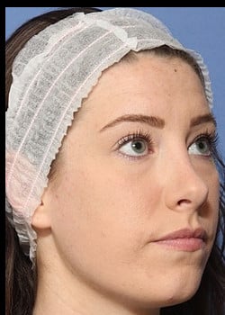 After Image: Rhinoplasty - front